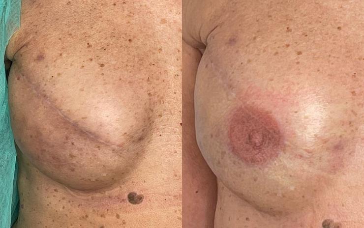 Unha paciente antes e despois da micropigmentación da areola e o pezón / Luisa Gragera