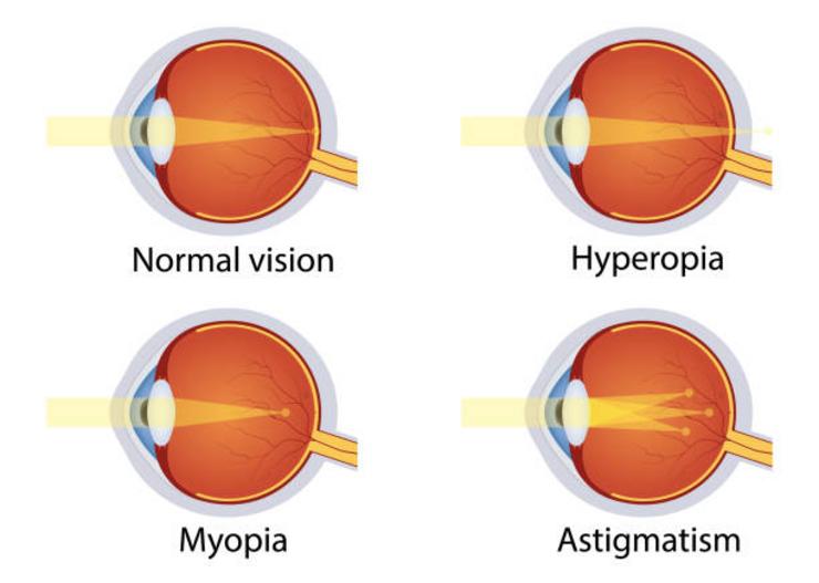 Diferentes afectacións á visión 